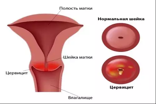 что такое цервицит